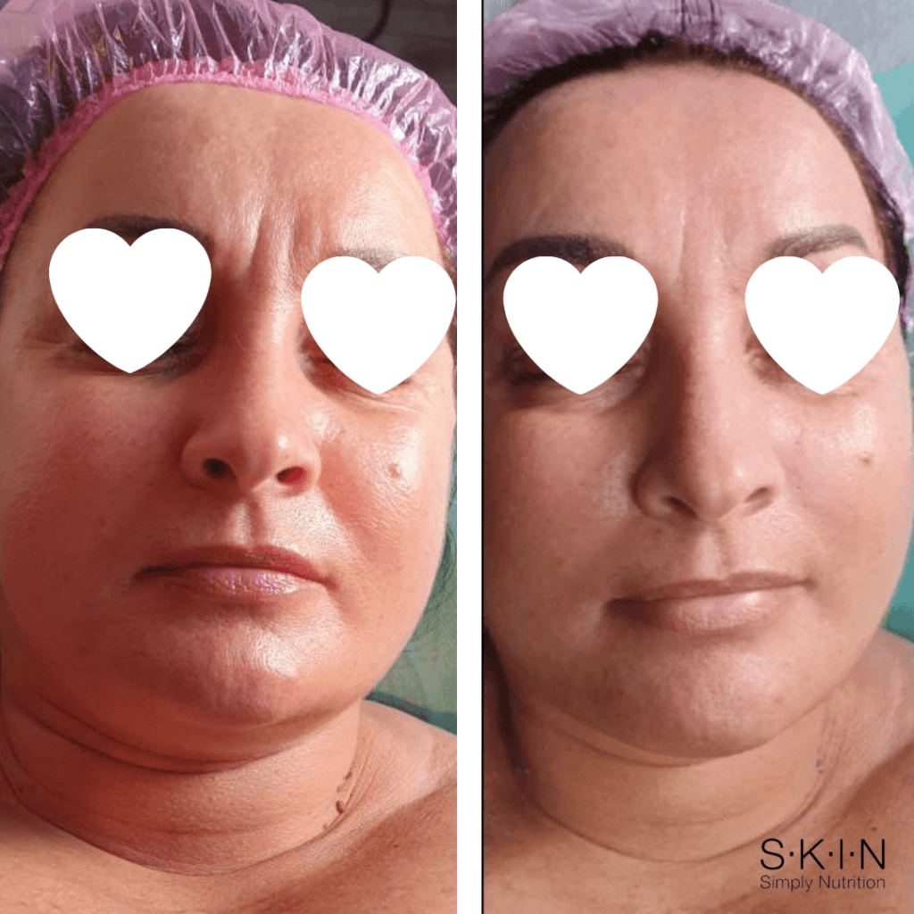 skinsn-blog-efekty-po-aplikacji-maski