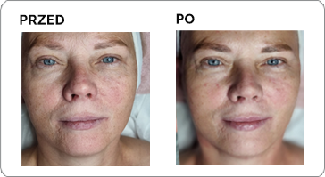 Zdjęcia przed i po terapii SKIN Simply Nutrition
